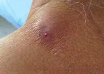 Activan cerco sanitario en Hopelchén tras detectar caso de miasis