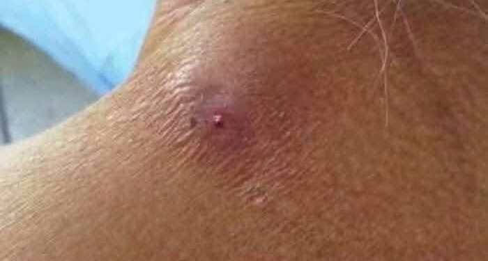 Activan cerco sanitario en Hopelchén tras detectar caso de miasis