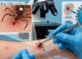 ¿Qué es el virus Bourbon? Confirman su presencia por primera vez en Nueva York